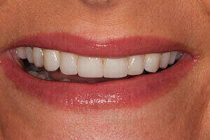 Image of teeth after treament