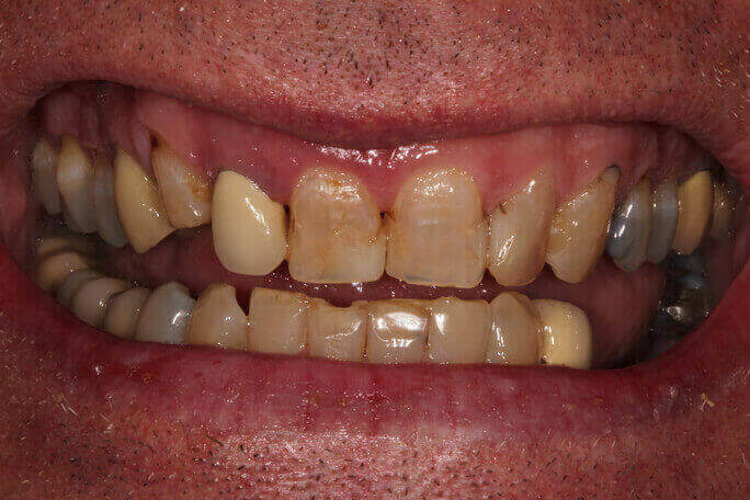 Image of teeth before treatment
